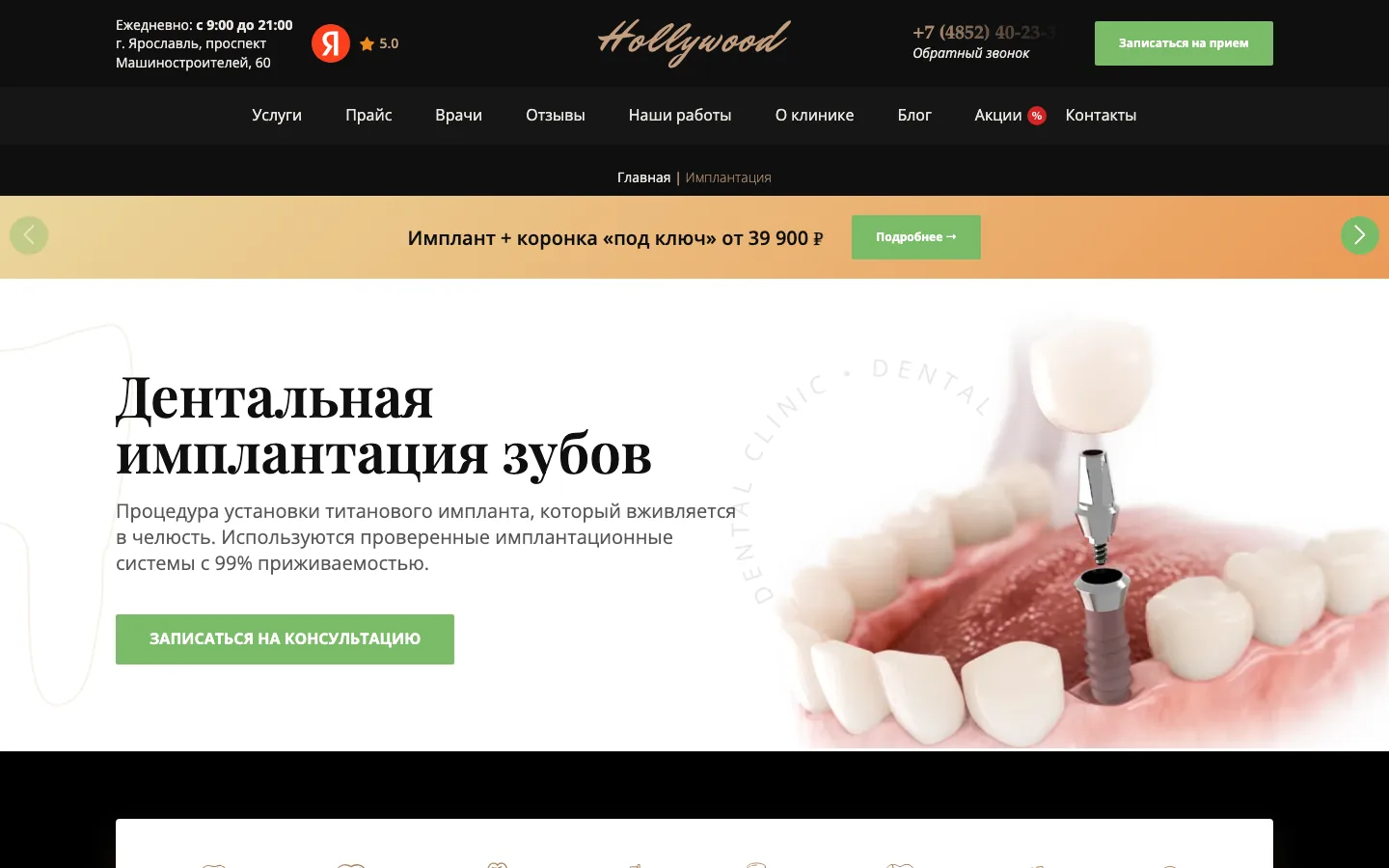 Страница услуги «Имплантация зубов» на сайте стоматологии «Голливуд»