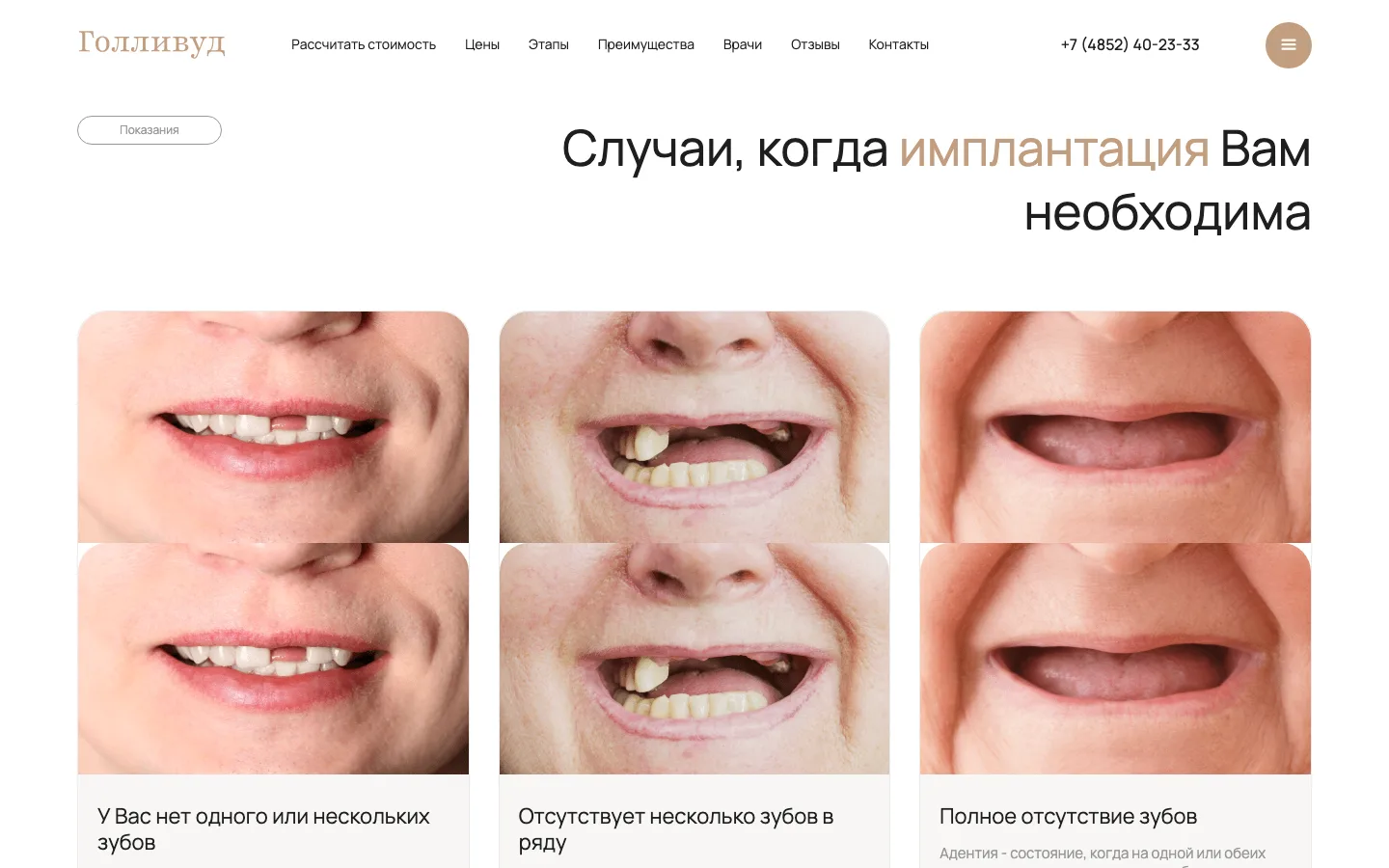 Блок «Случаи, когда имплантация вам необходима» с кнопками «Это мой случай» на лендинге «Голливуд»