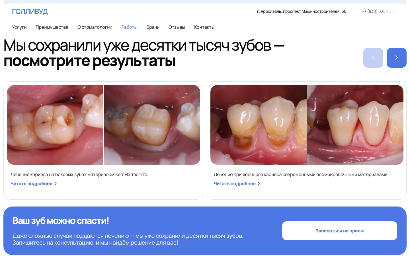 Слайдер работ до и после лечения кариеса на лендинге стоматологии «Голливуд»