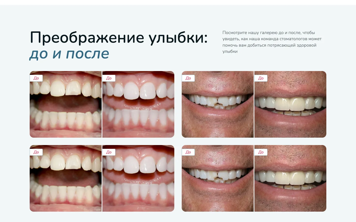 Галерея «Преображение улыбки: до и после» на сайте «Оптима Дент»